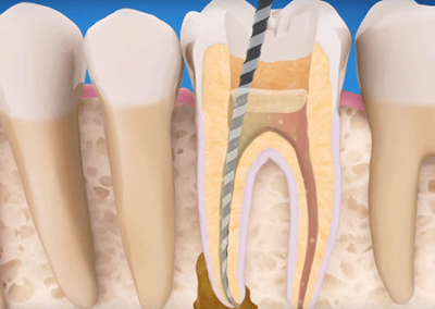 bfc_endodontics_price