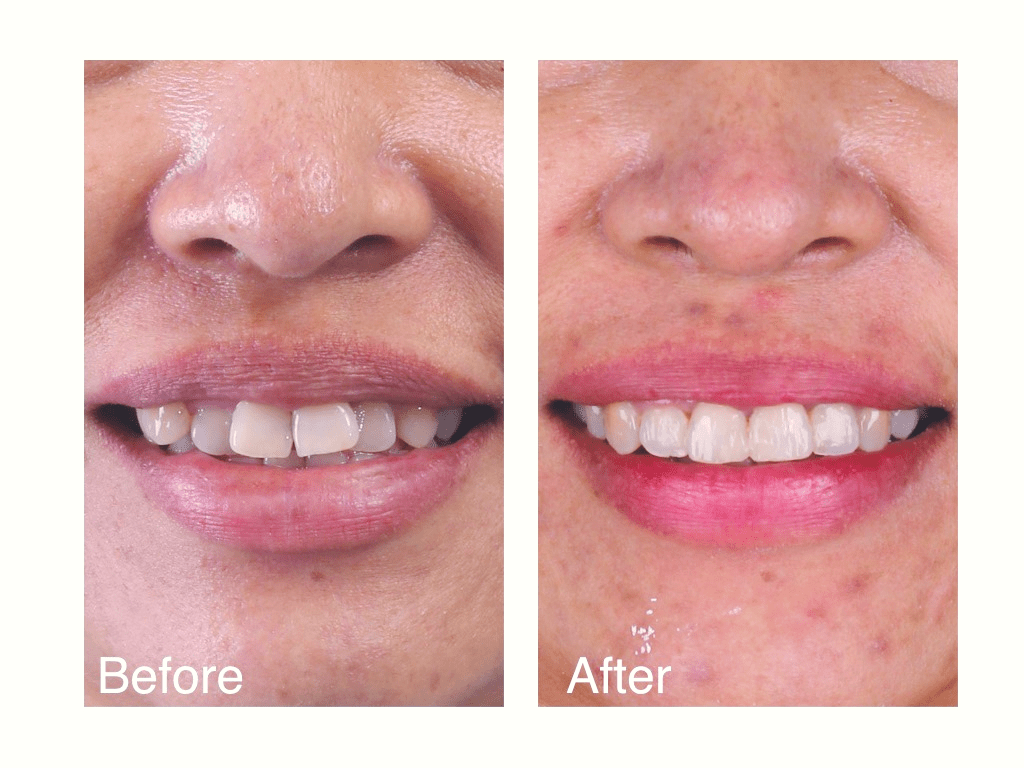 จัดฟันใส Clearsmile