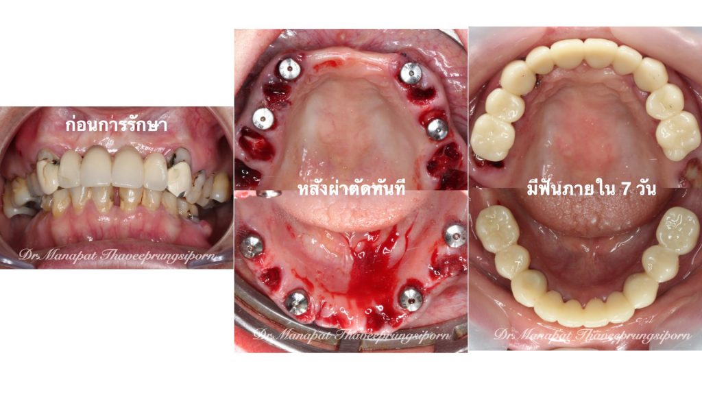 ฟันโยกทั้งปาก