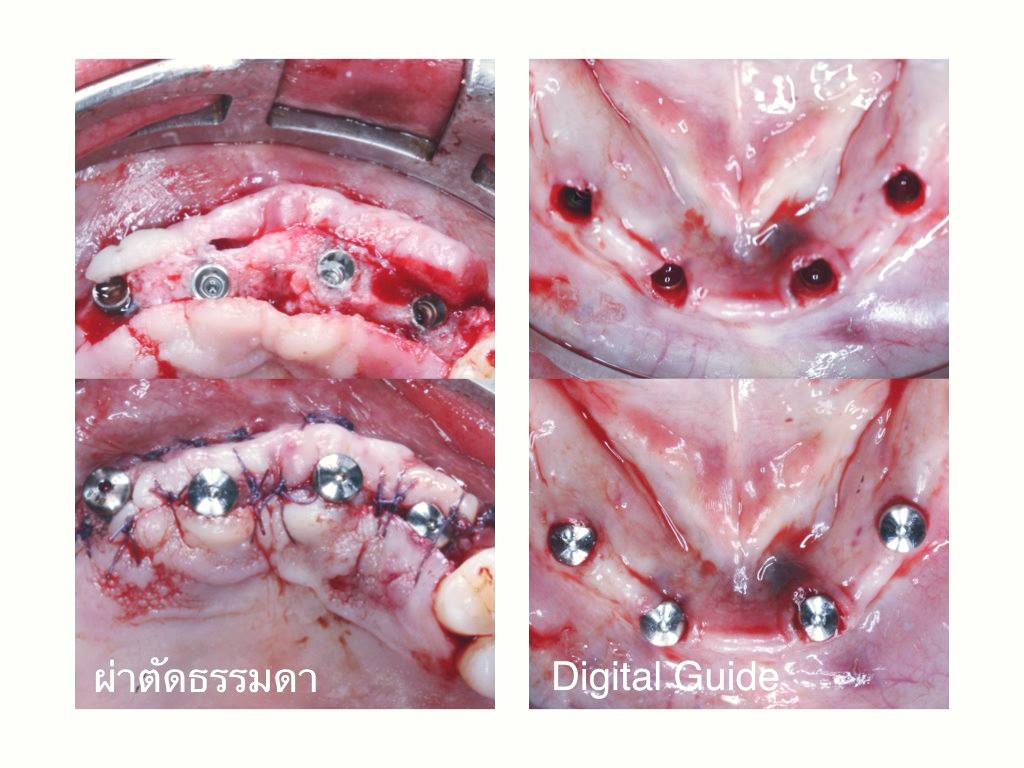 ทำรากเทียมทั้งปาก