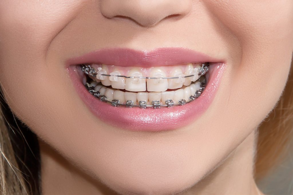 จัดฟันรอบสอง แบบเร็ว ด้วย Wepass ระบบ Self Ligating - Bfc Dental