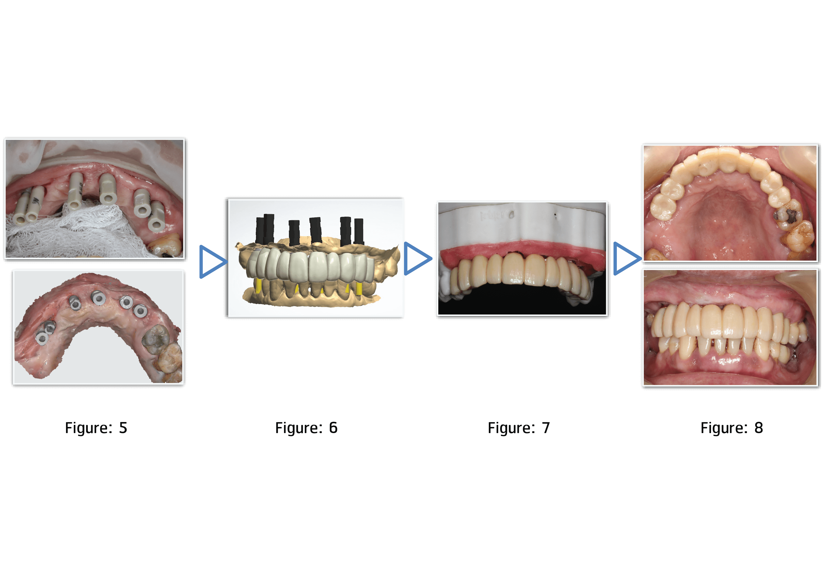 intraoral scanner คือ