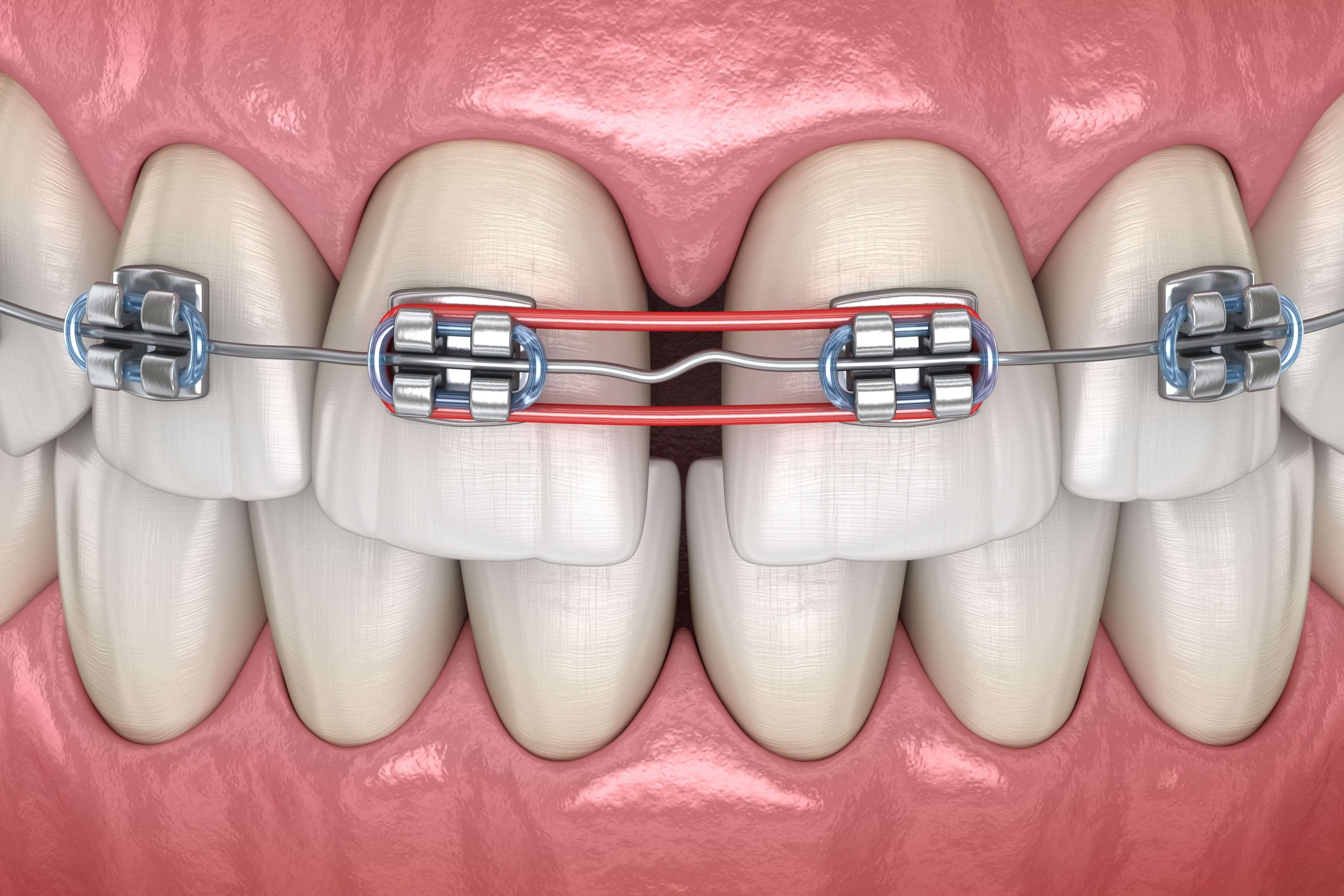 ยางดึงฟัน ที่ฉันไม่อยากเจอ - Bfc Dental