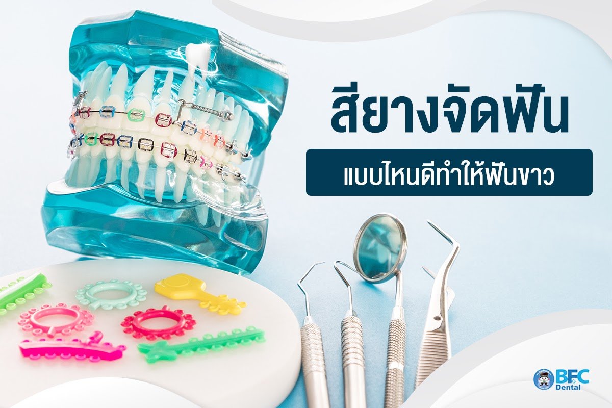 สียางจัดฟัน แบบไหนดีทำให้ฟันขาว - Bfc Dental - Bfc Dental