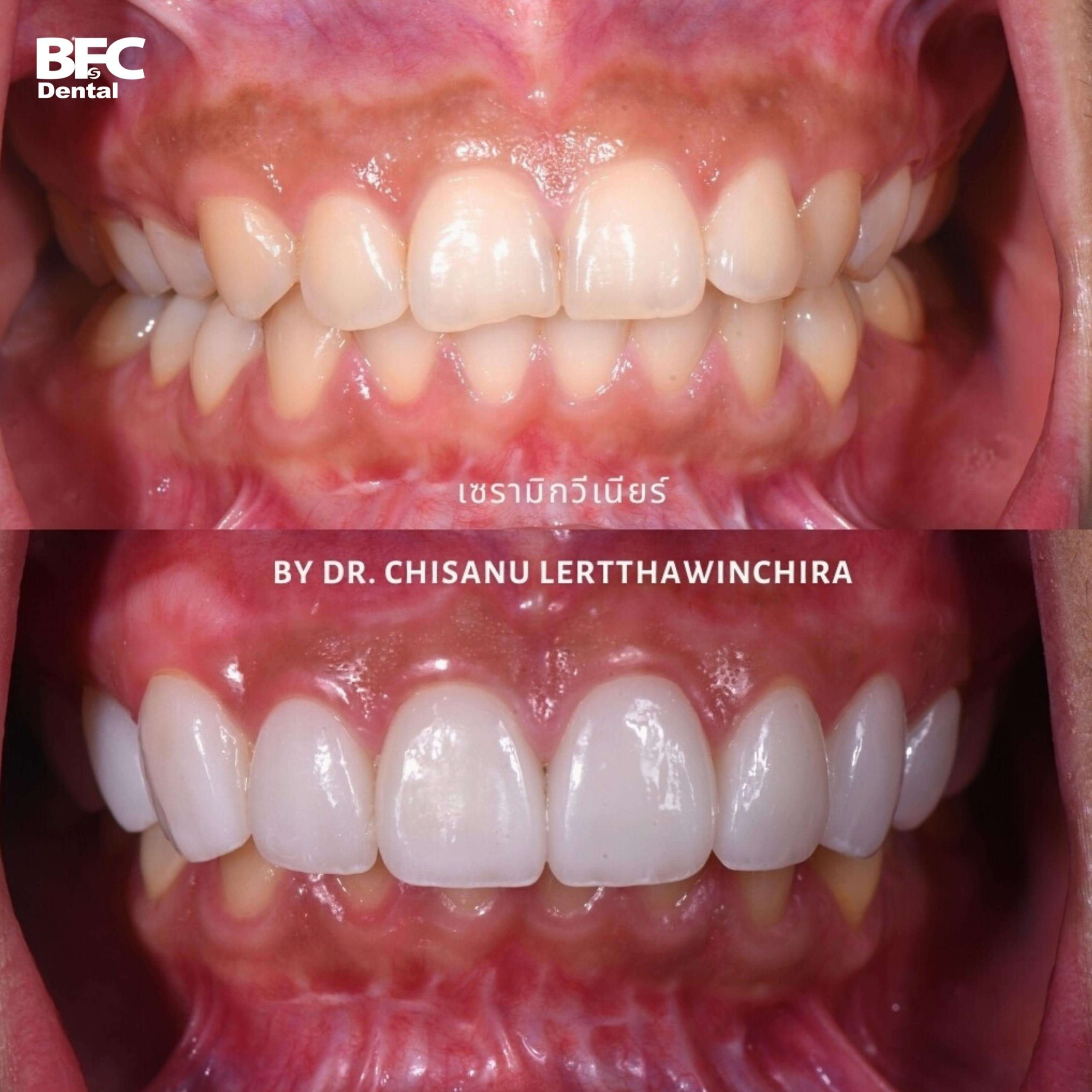 1.ceramic-veneer