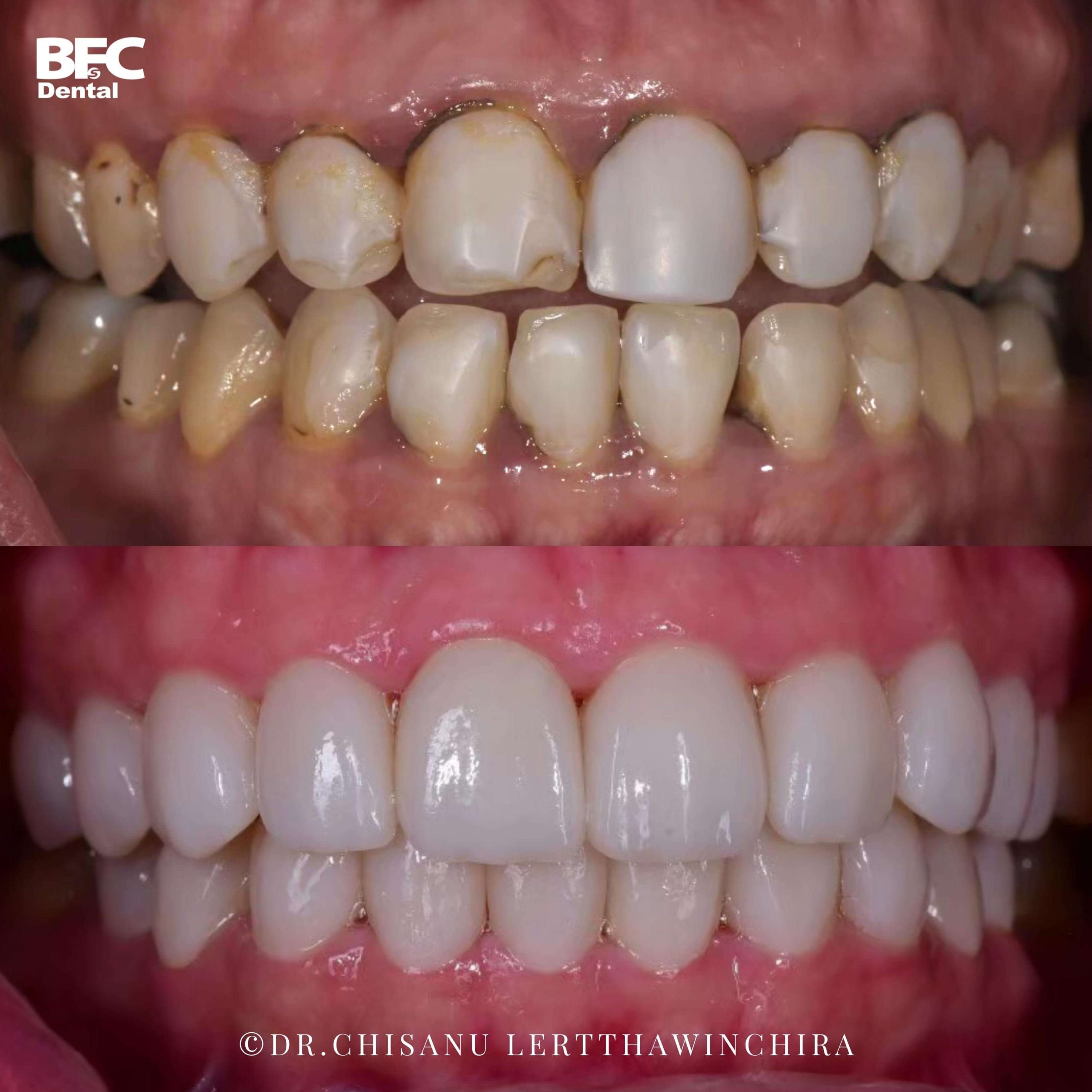 10.-fix-composite-veneers-to-ceramic-veneers