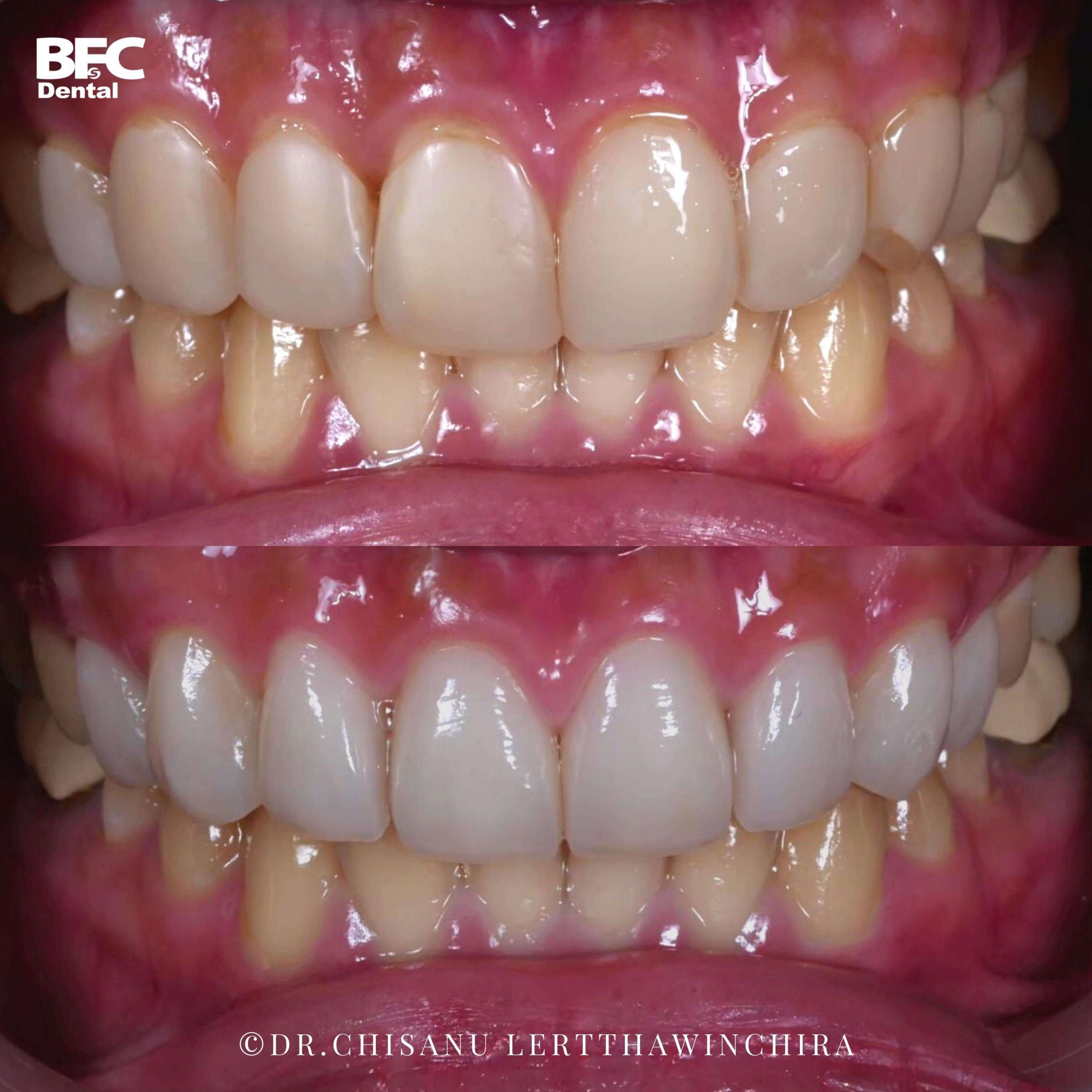 11.composite-veneers