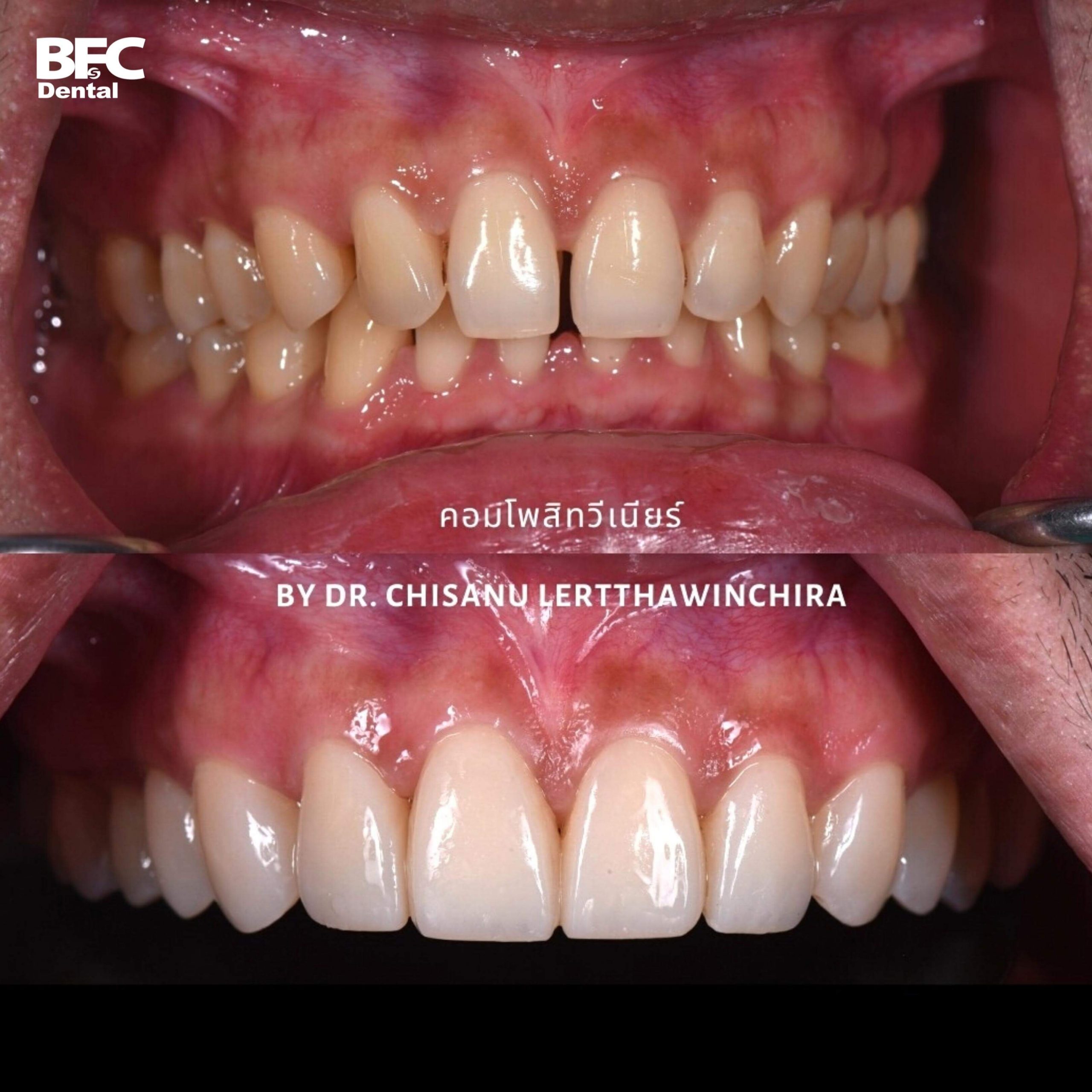 12.-composite-veneers