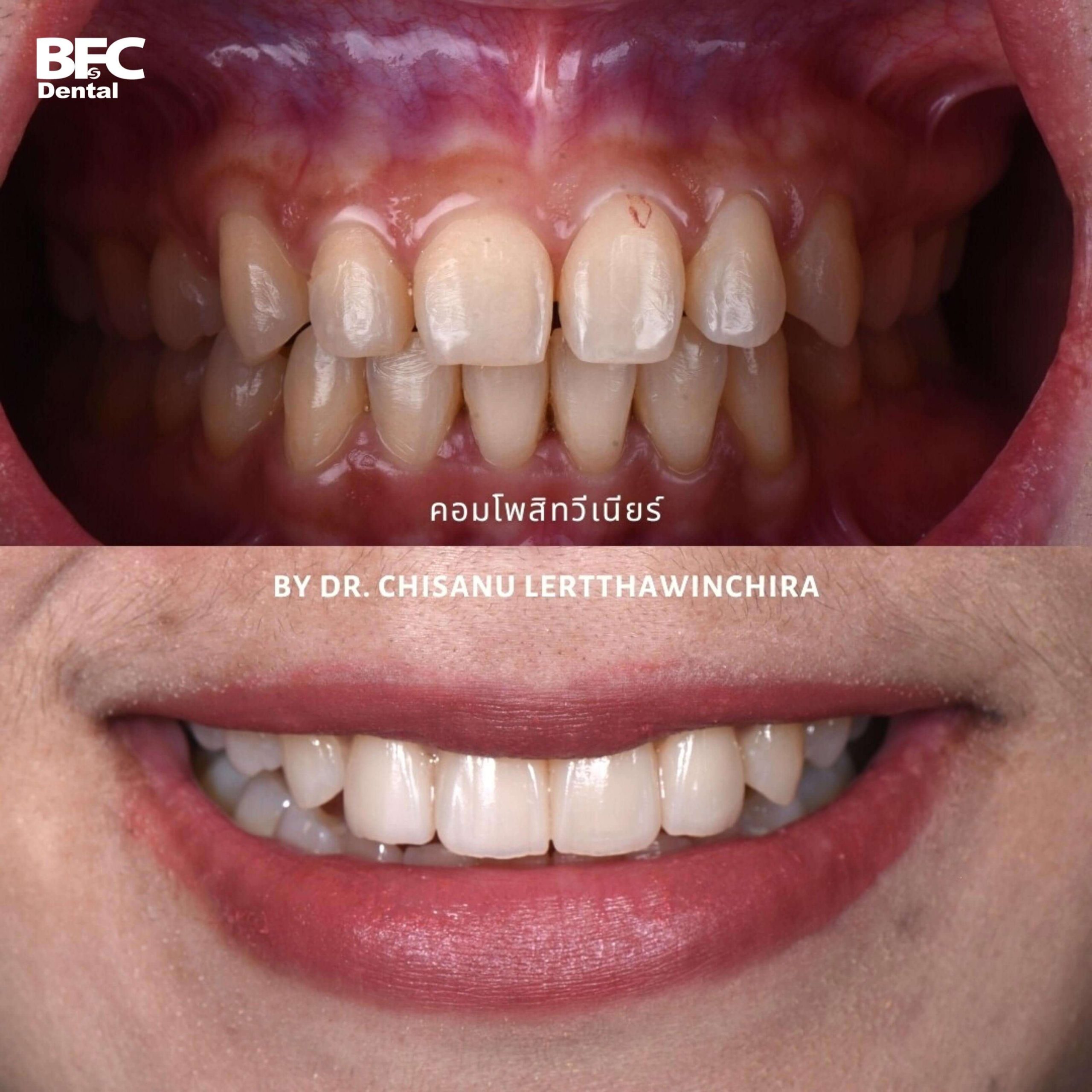 13.-composite-veneers