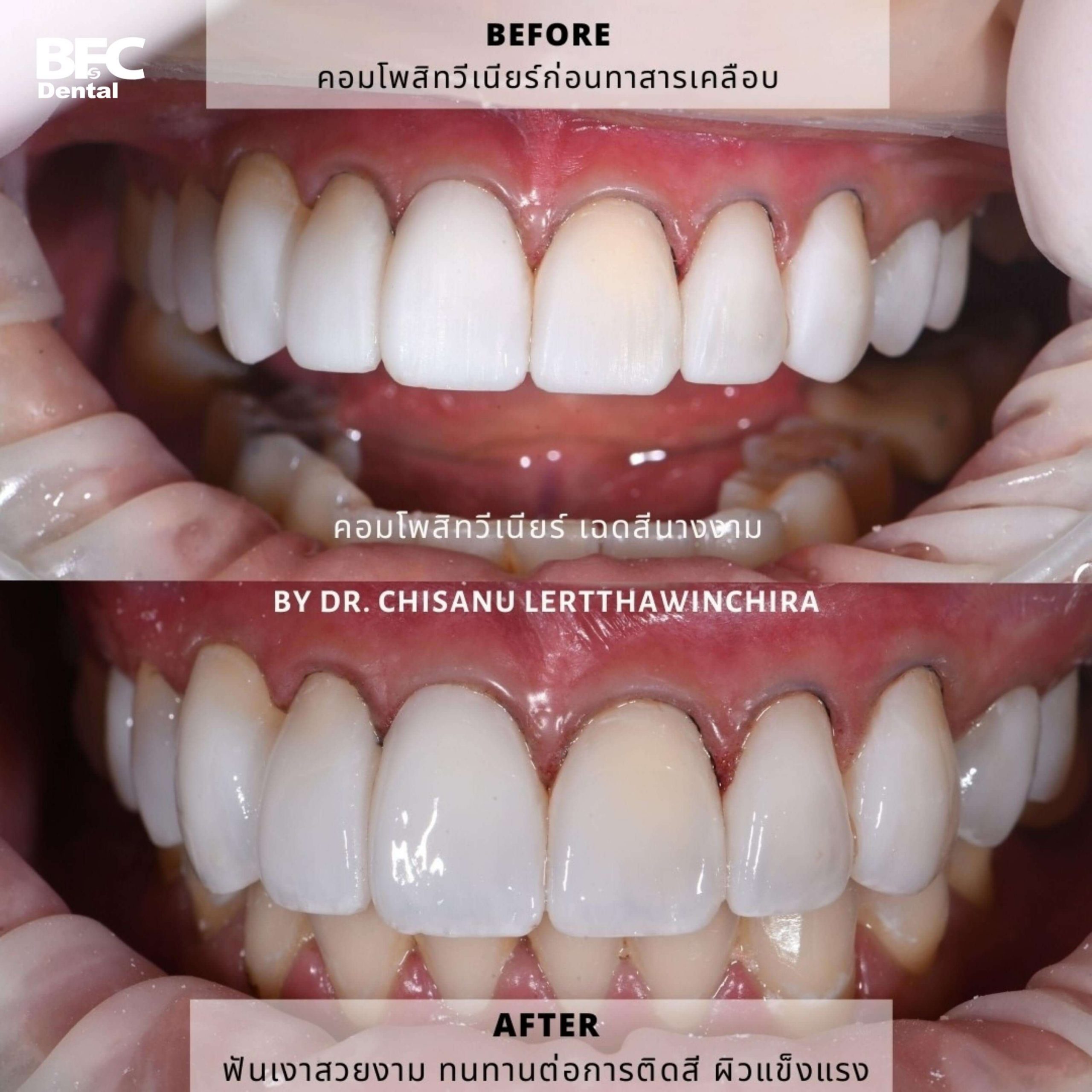 14.-composite-veneers