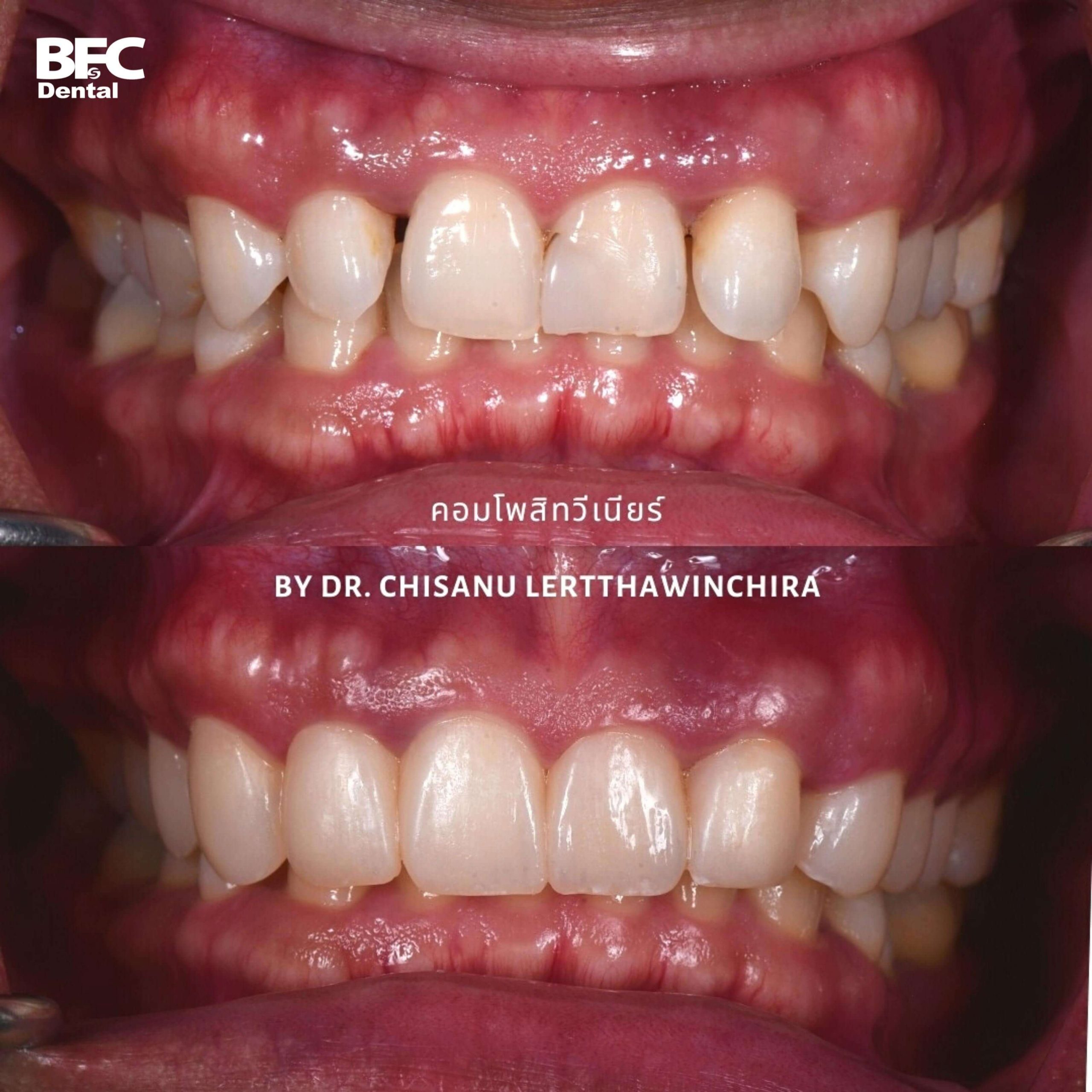 15.-composite-veneers