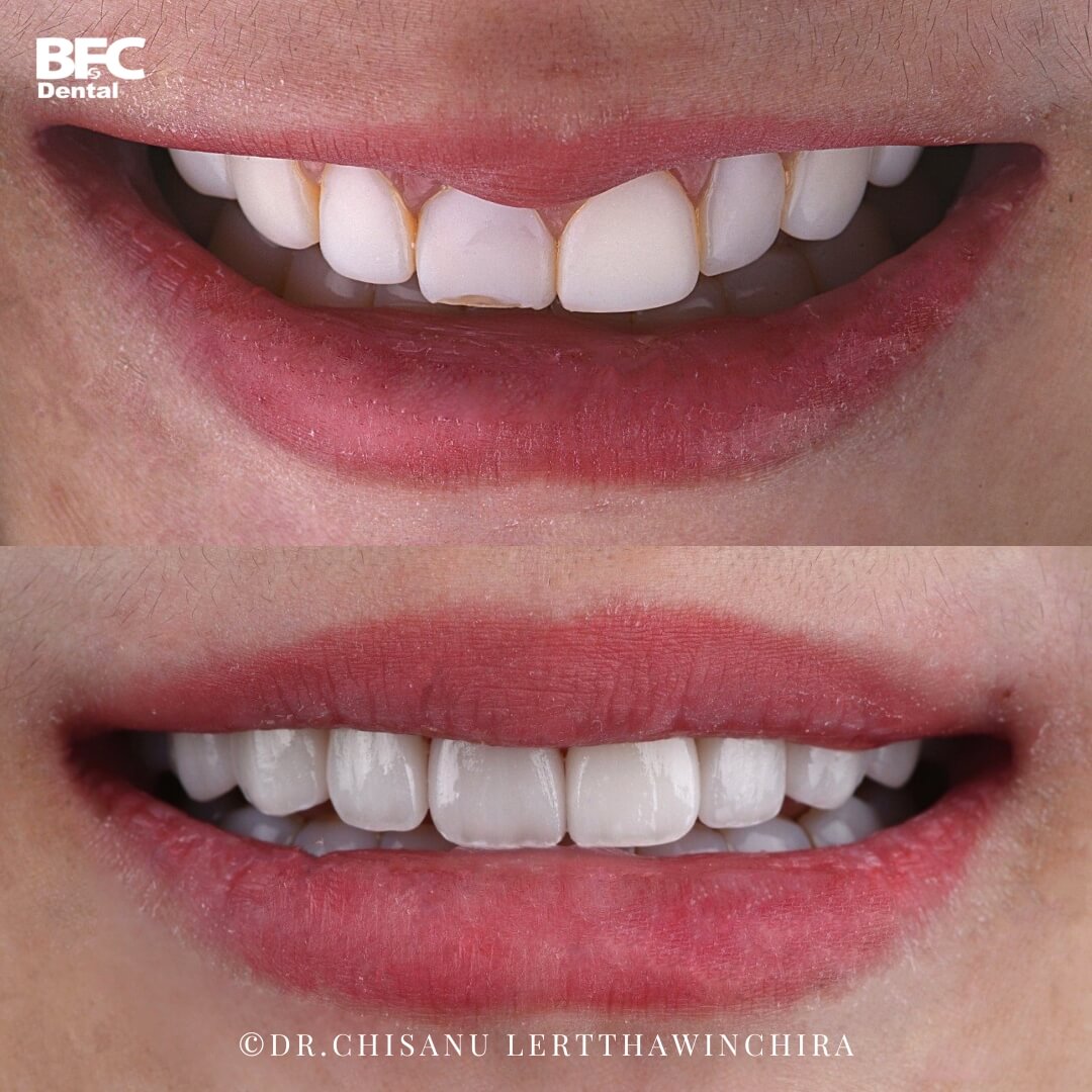 18.-composite-to-ceramic-veneers