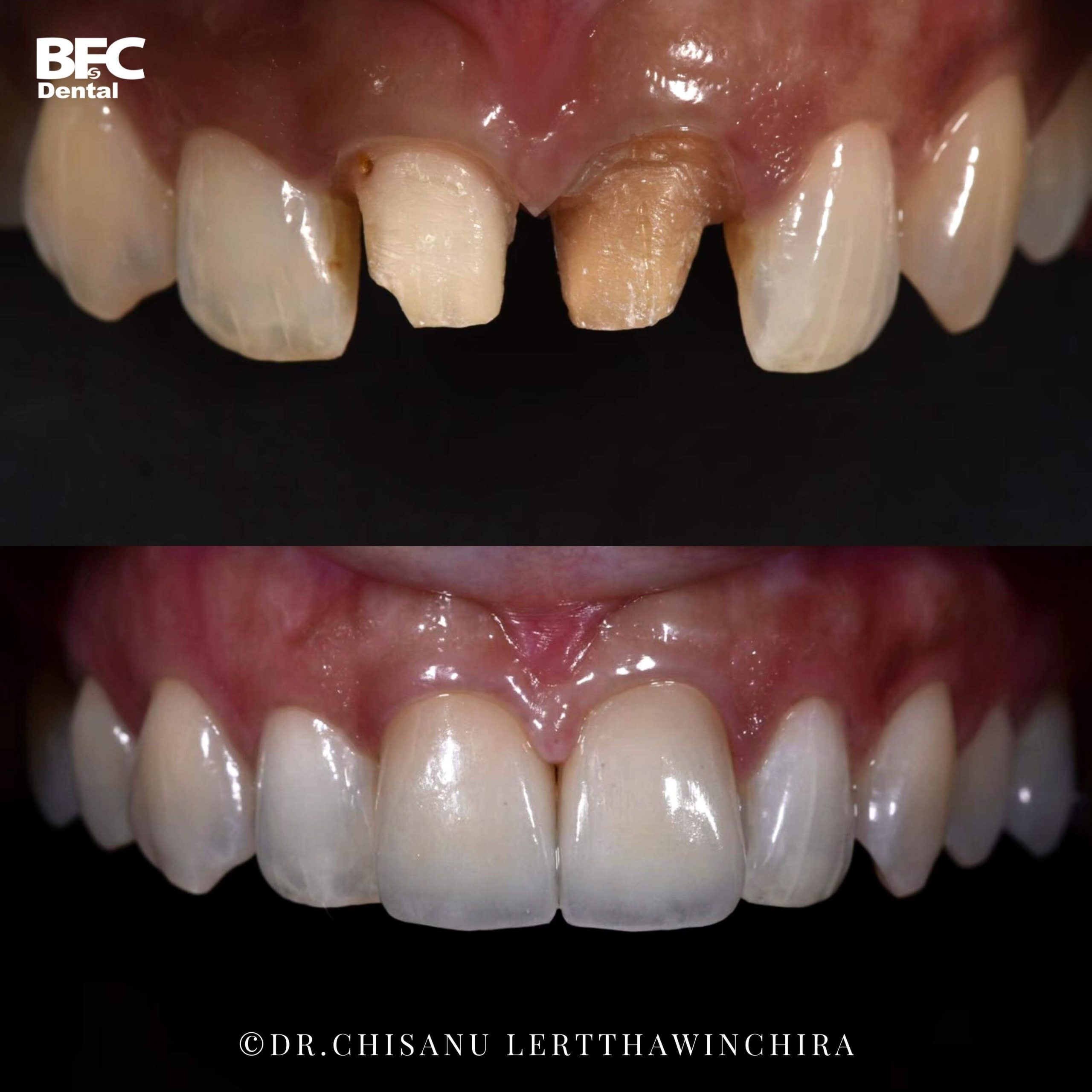 3.ceramic-veneers