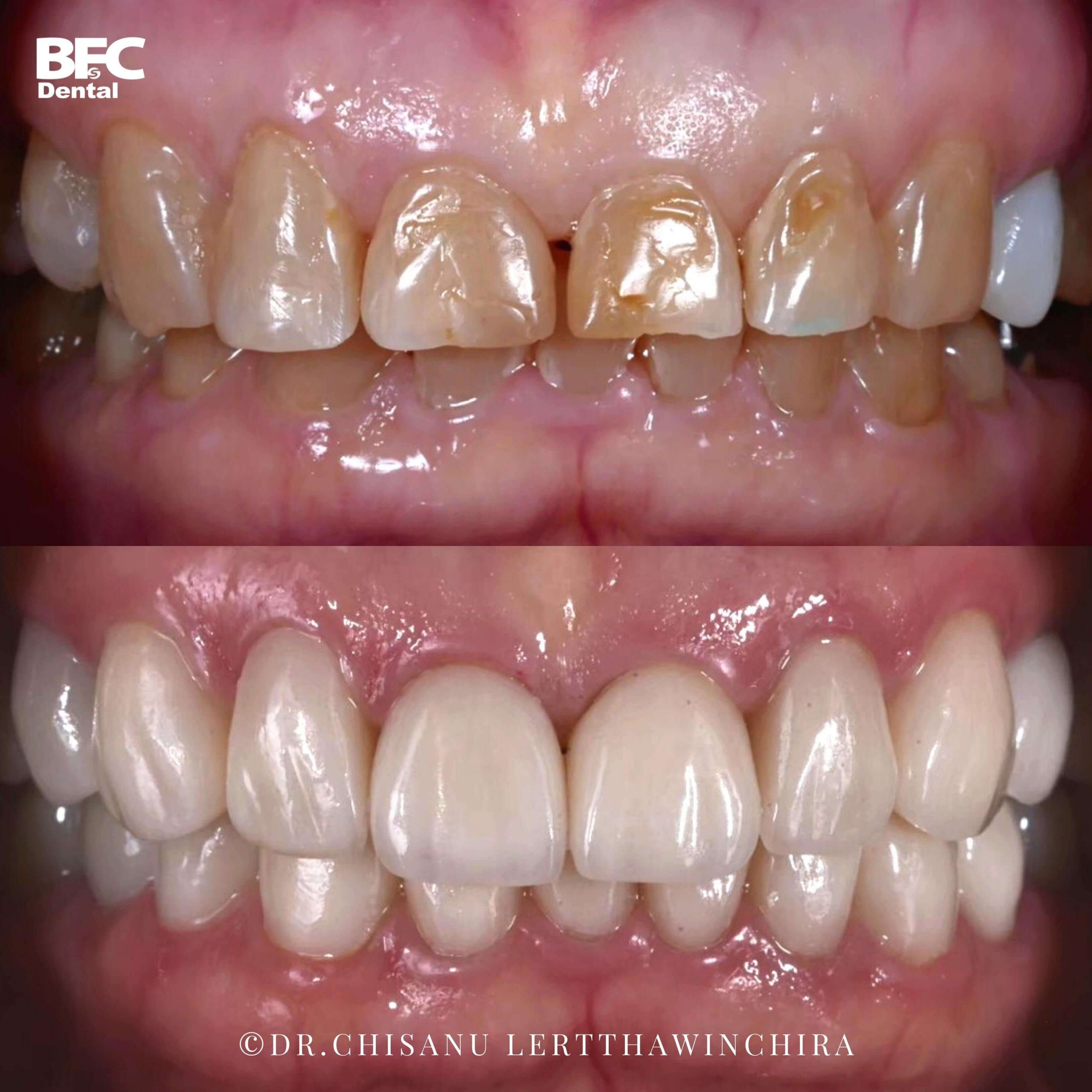 4.ceramic-veneers-4