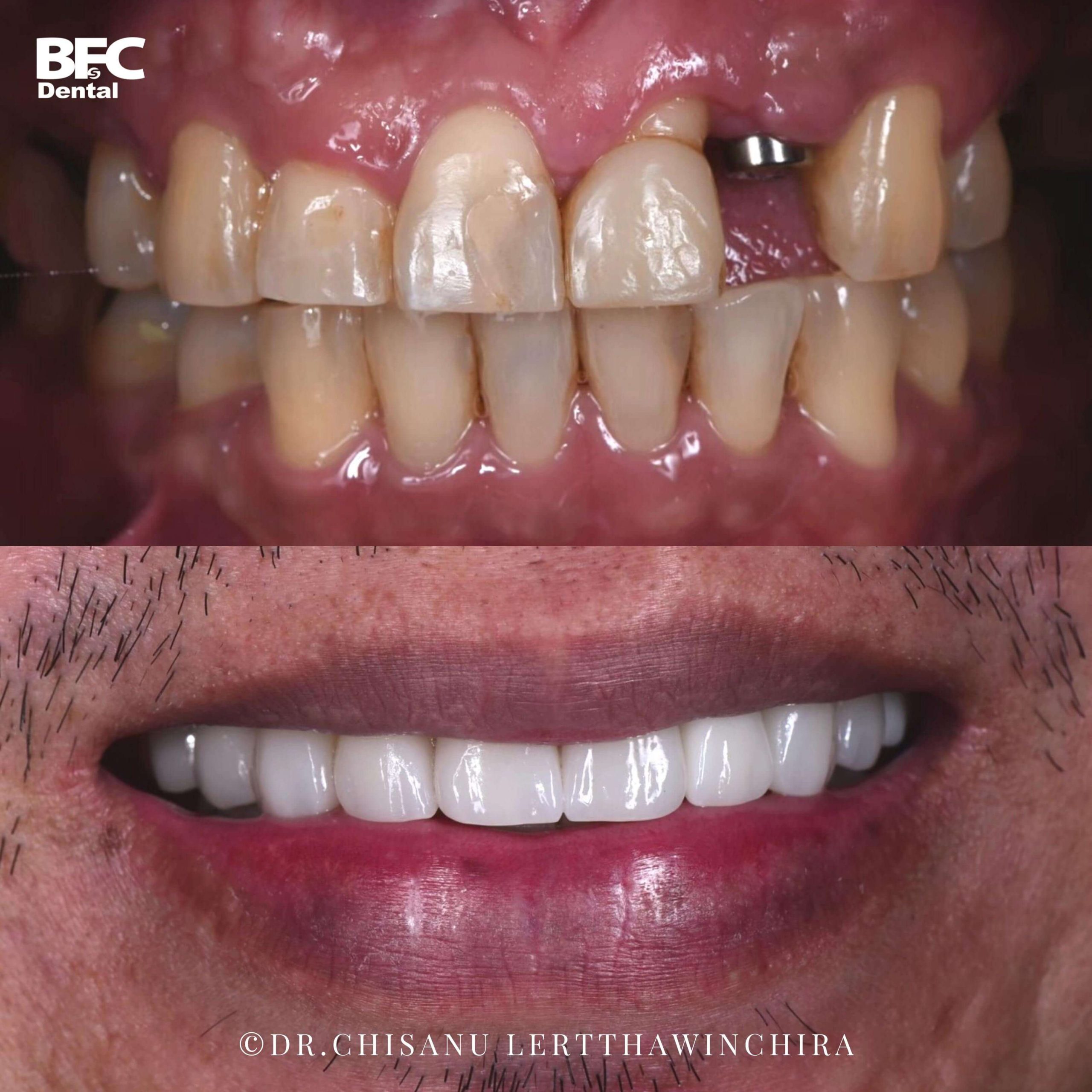 5.ceramic-veneers-crown