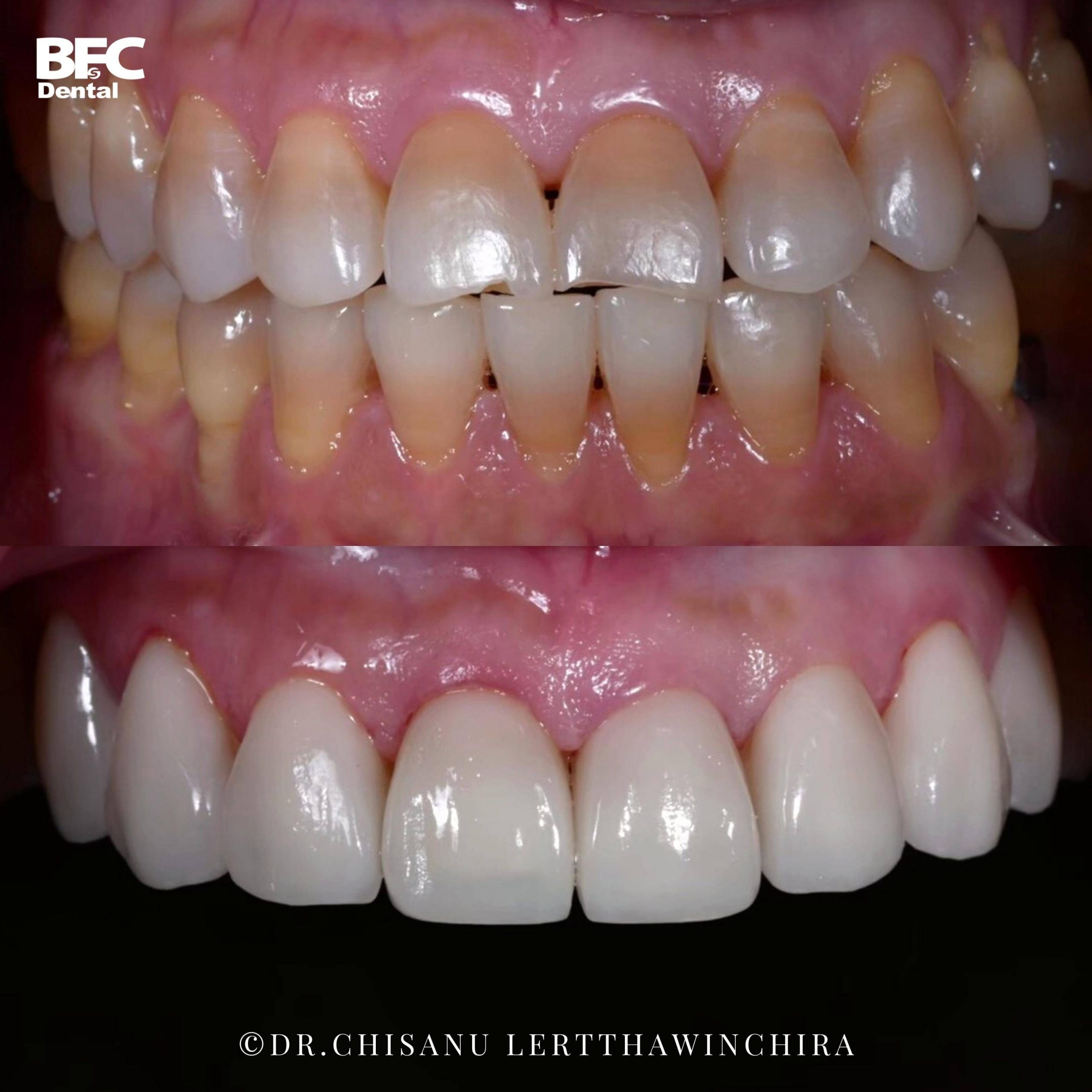 6.ceramic-veneers