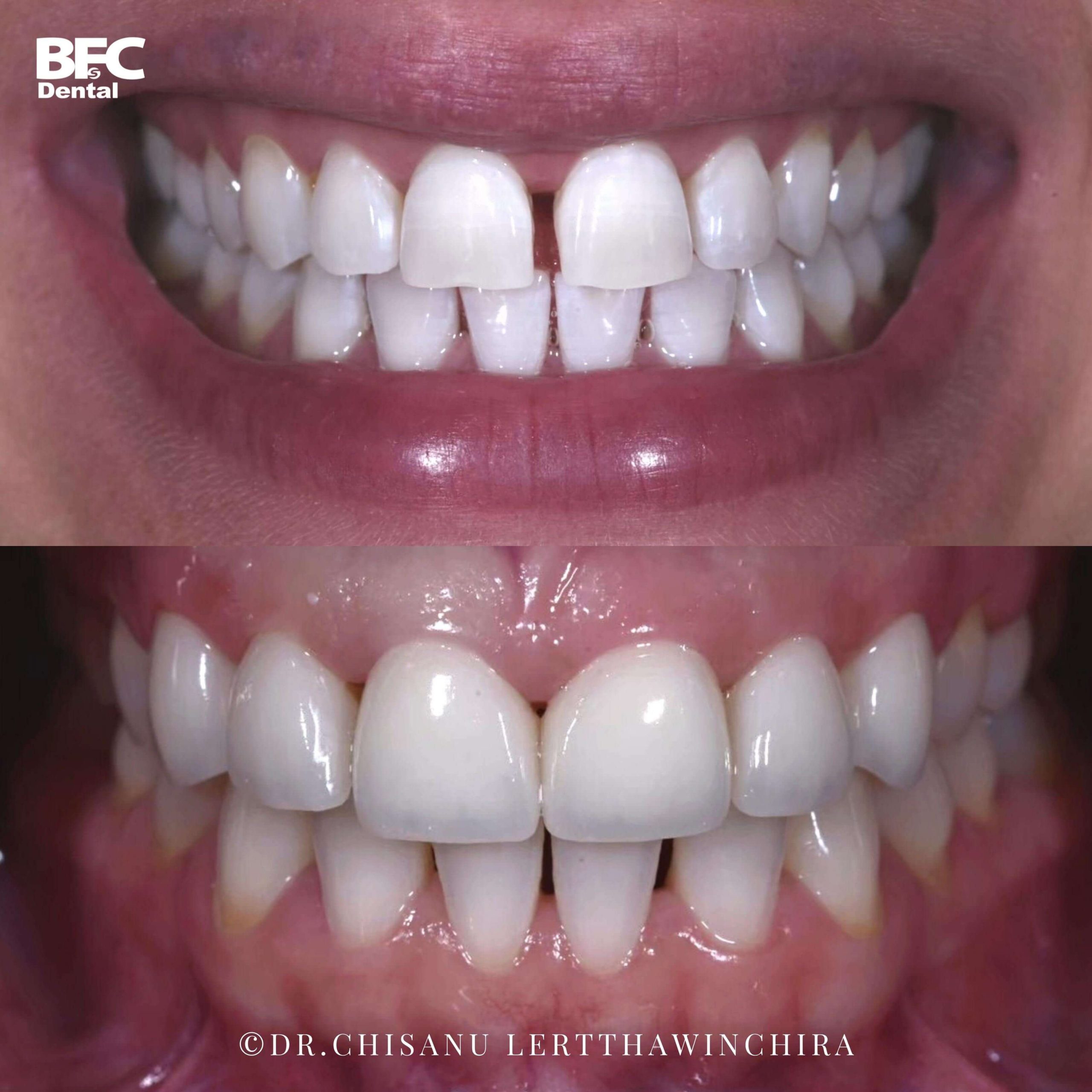 7.ceramic-veneers