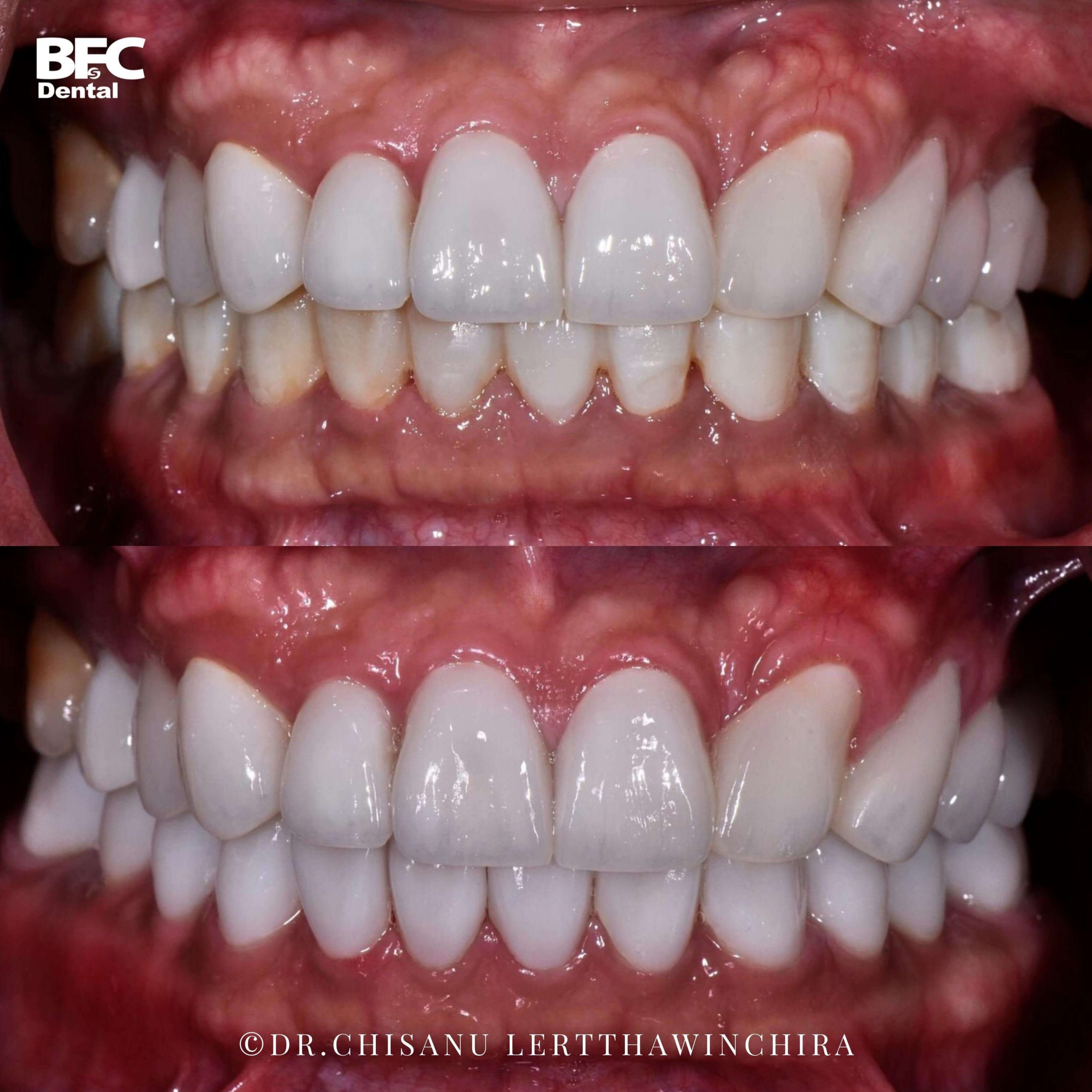 8.ceramic-veneers