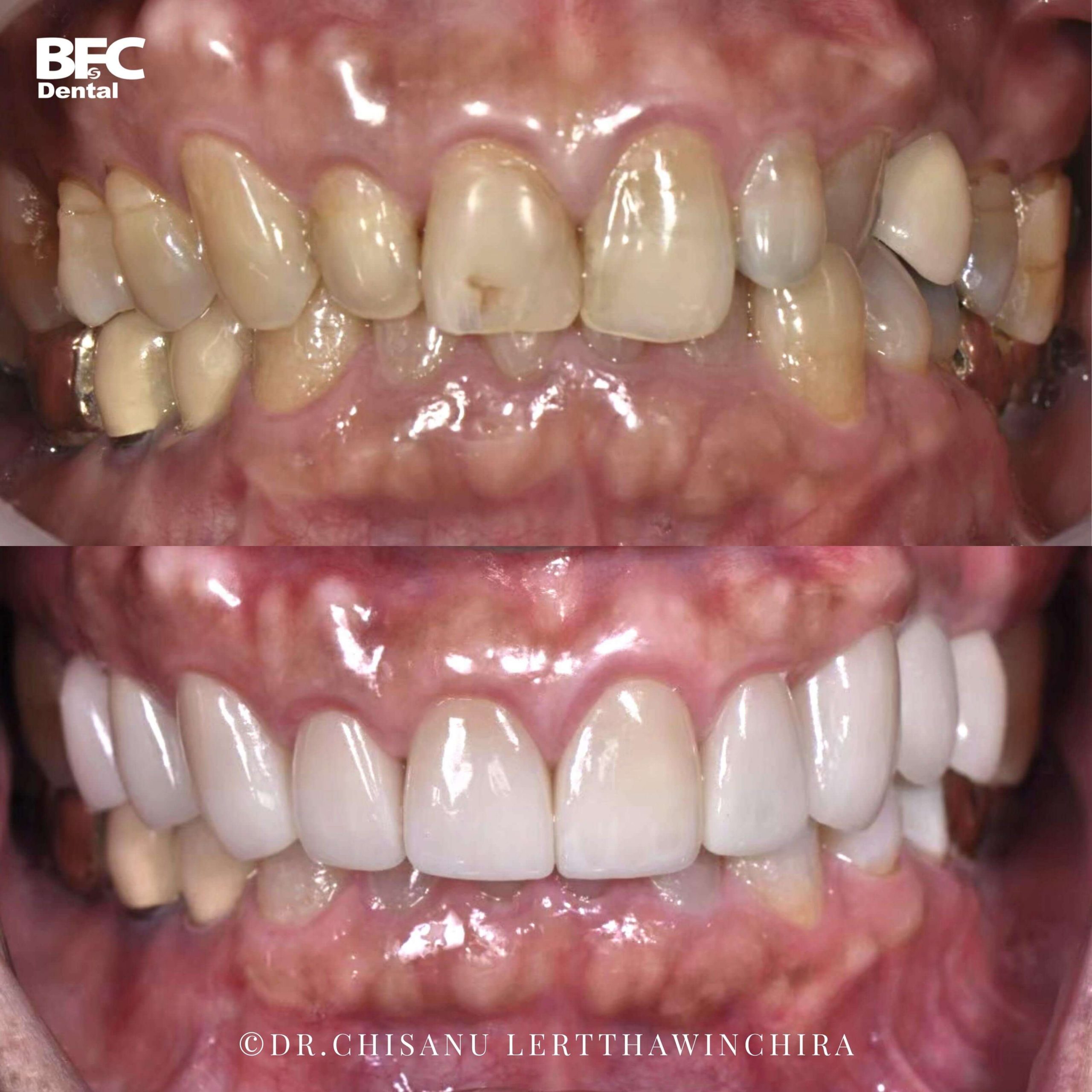 9.-ceramic-veneers-clear-aligner