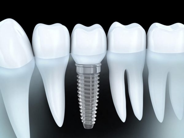 Conventional Dental Implants