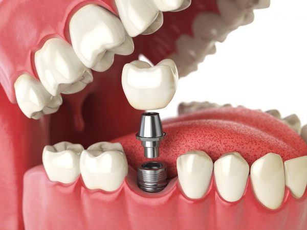 New Dental Implants